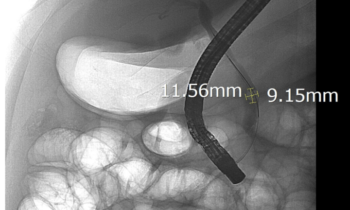 Đau bụng, vàng da kéo dài: Dấu hiệu tắc mật nguy hiểm không nên bỏ qua