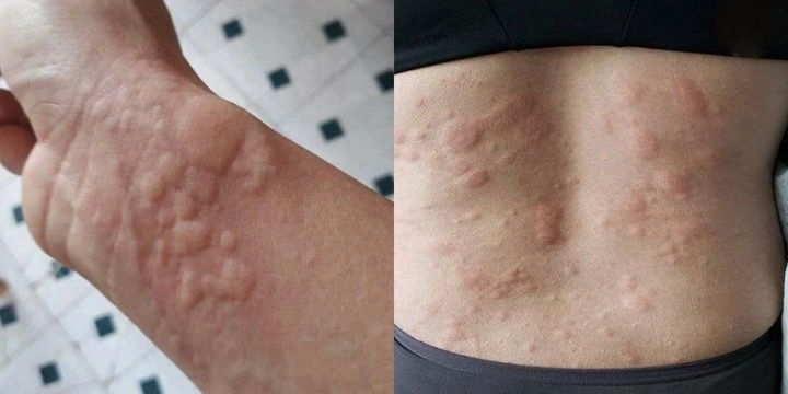 Sau bữa tiệc tất niên, người đàn ông Hà Nội nhập viện vì dị ứng 