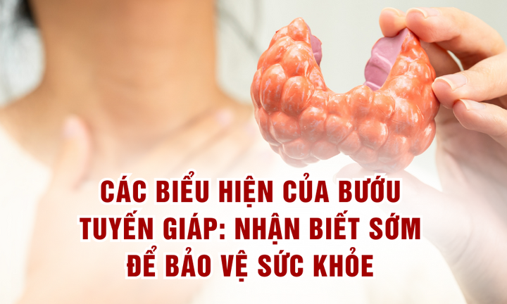 Các biểu hiện của bướu tuyến giáp: Nhận biết sớm để bảo vệ sức khỏe