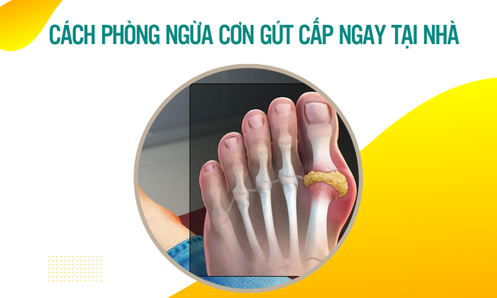 Cách phòng ngừa cơn gút cấp ngay tại nhà 
