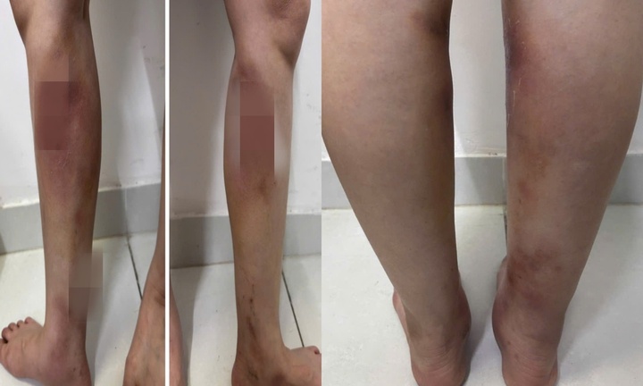 Biến dạng đôi chân sau khi tiêm filler làm thẳng chân tại nhà
