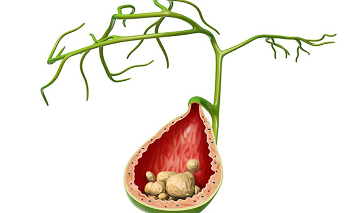 [Giải đáp] Vì sao sỏi mật hay tái phát và cách phòng ngừa hiệu quả