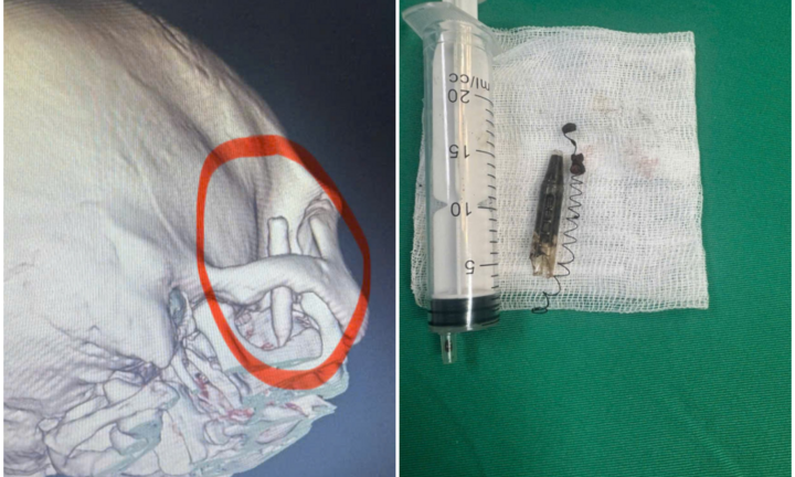 Phẫu thuật lấy lò xo bút bi tồn tại suốt 13 năm trong vùng thái dương của nam bệnh nhân