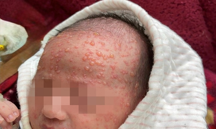 Trẻ sơ sinh 12 ngày tuổi nguy kịch vì thủy đậu, bác sĩ cảnh báo biến chứng không thể chủ quan