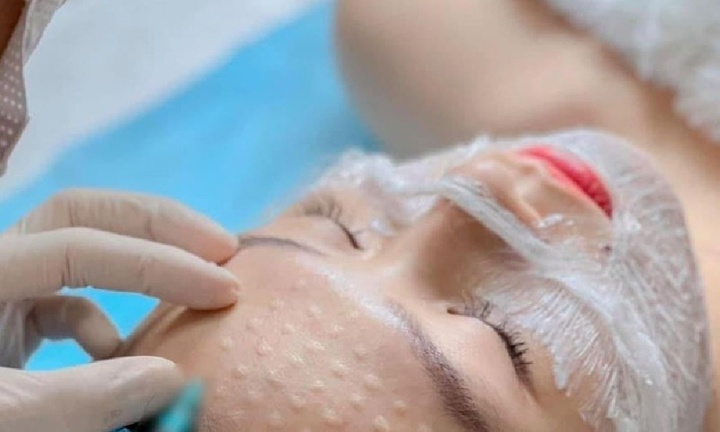 Người phụ nữ bị nhiễm trùng nặng, sưng phù toàn mặt sau tiêm meso tại nhà