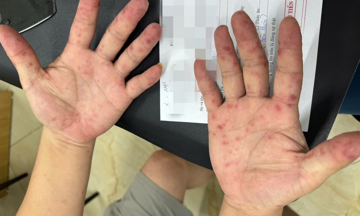 Cảnh báo sai lầm nhiều phụ huynh mắc khi bệnh chân tay miệng đang vào mùa