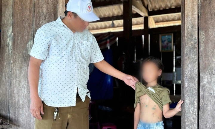 Một điểm trường ở Đắk Lắk phải cho học sinh nghỉ học vì giáo viên, học sinh bị mắc thủy đậu