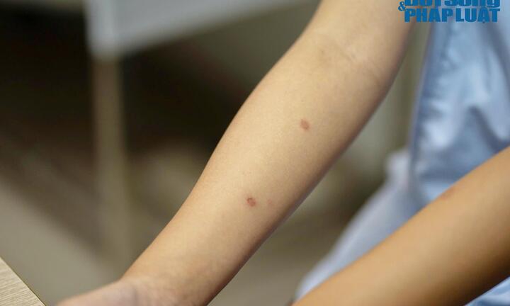 Nắng nóng gia tăng các bệnh da liễu: Sai lầm tai hại khiến bệnh trở nặng