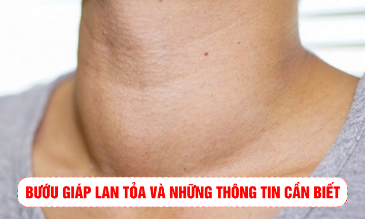 Bướu giáp lan tỏa và những thông tin cần biết