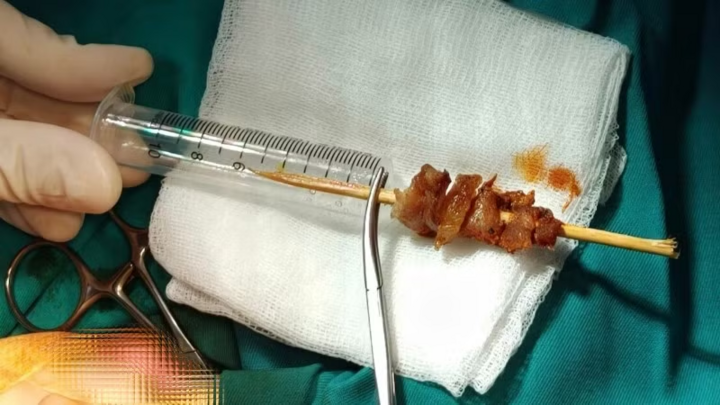 Bé gái 2,5 tuổi gặp nạn khi ăn thịt xiên nướng