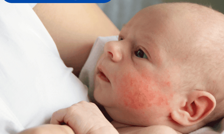 Viêm da ở trẻ nhỏ: Hiểu đúng để chăm sóc hiệu quả