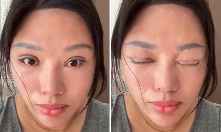 Cắt mí mắt hỏng đến mức tàn tật, nạn nhân vẫn phải đền tiền tỷ cho thẩm mỹ viện