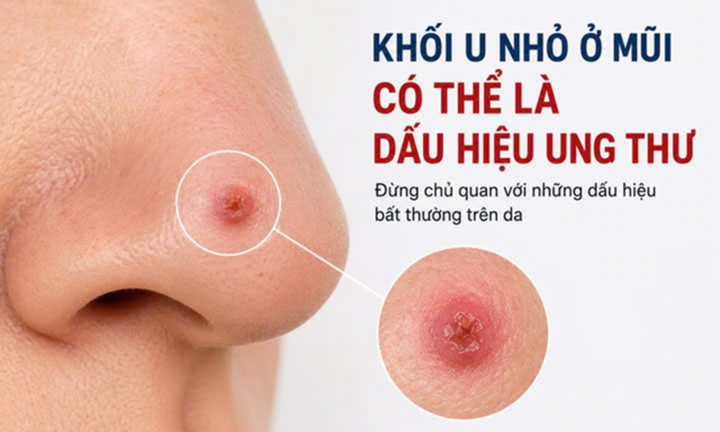 Dấu hiệu ung thư da dễ nhầm với mụn thông thường