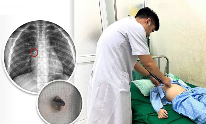 Được mẹ nhổ răng tại nhà, bé trai phải nhập viện sau sự cố hy hữu