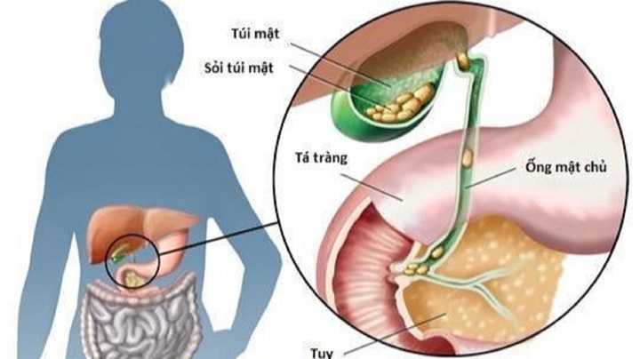 Sỏi túi mật hình thành do đâu và cách kiểm soát hiệu quả