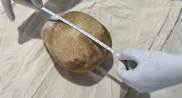 Cận cảnh viên sỏi nặng 3,1kg được các bác sĩ lấy ra khỏi bàng quang của người đàn ông 55 tuổi