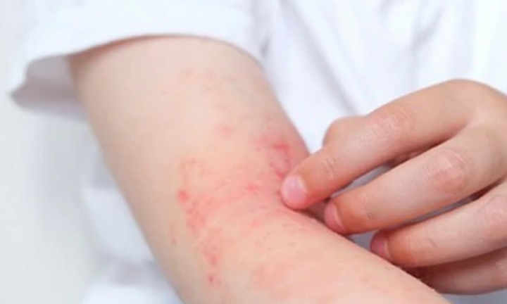Vì sao trẻ dễ bị viêm da? Hiểu đúng để chăm sóc da hiệu quả