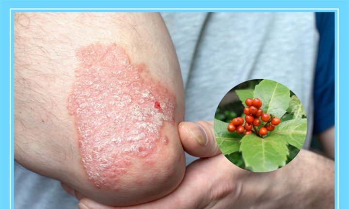 Giải pháp thảo dược hỗ trợ kiểm soát vảy nến hiệu quả, hạn chế tác dụng phụ khi dùng lâu dài