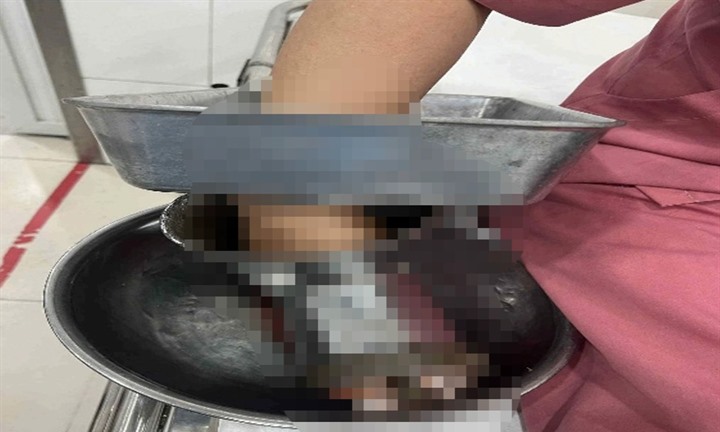 Nấu ăn tại trường học, người phụ nữ gặp tai nạn nghiêm trọng khi sử dụng máy xay thịt