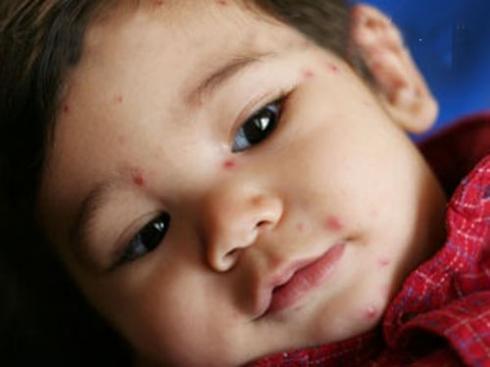 Dấu hiệu và cách chăm sóc bệnh nhân bị thủy đậu