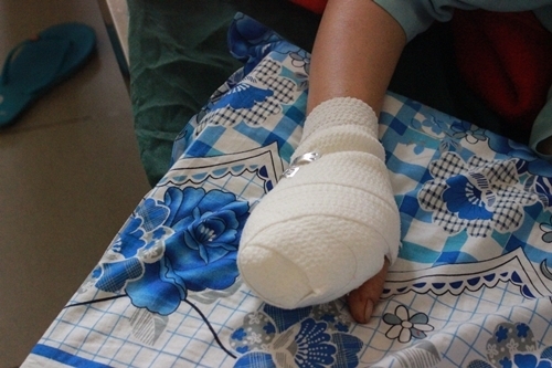 Người phụ nữ bị máy xay thịt nghiền nát 4 ngón tay