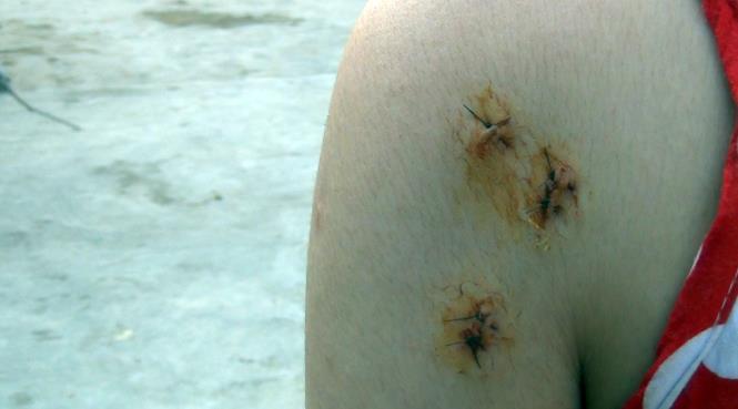 Truy bắt nhóm cướp bịt mặt đâm kim tiêm, cướp xe nạn nhân