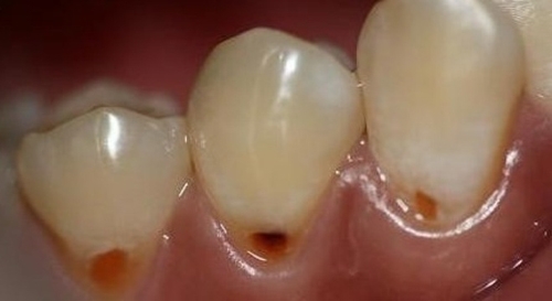 Răng hỏng gây hại đến cơ thể như thế nào?