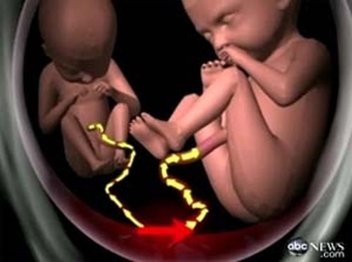 Rơi nước mắt hành trình cứu song thai bất thành của mẹ Việt