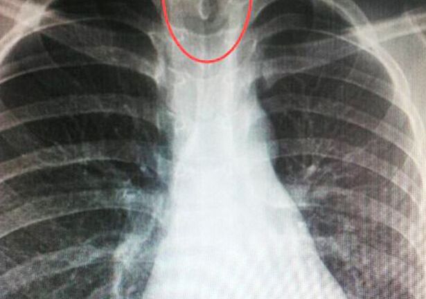 Đỉa 7cm sống trong cổ họng bé trai