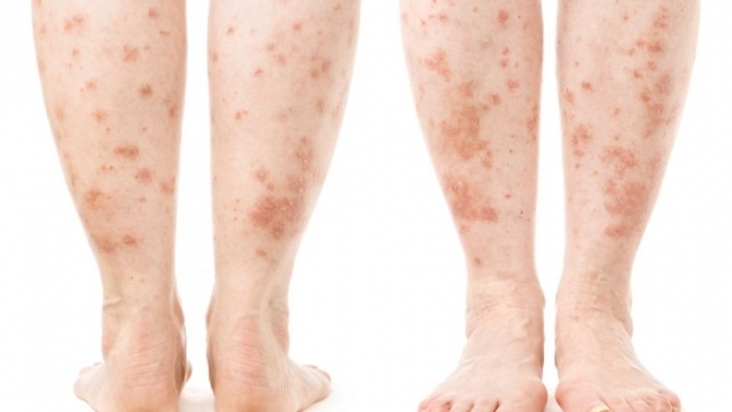 4 bệnh ngoài da cảnh báo thêm các vấn đề sức khỏe