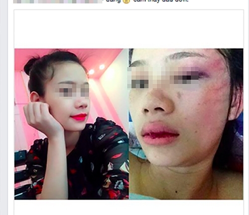 Cô gái xinh đẹp chia sẻ ảnh bị người yêu đánh thâm tím mặt