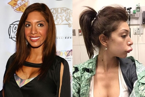 Nỗi khổ sau những sản phẩm phẫu thuật thẩm mỹ thất bại