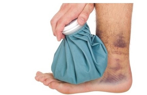 Mẹo đánh bay các vết bầm tím nhanh và đơn giản