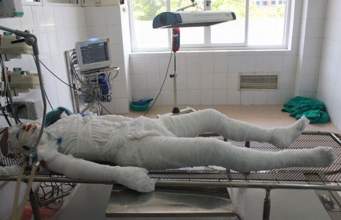 Xót xa bé trai 13 tuổi bị điện cao thế giật cháy như ngọn đuốc