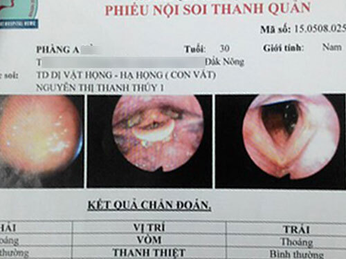 Kinh hoàng phát hiện đỉa trong họng một nam thanh niên
