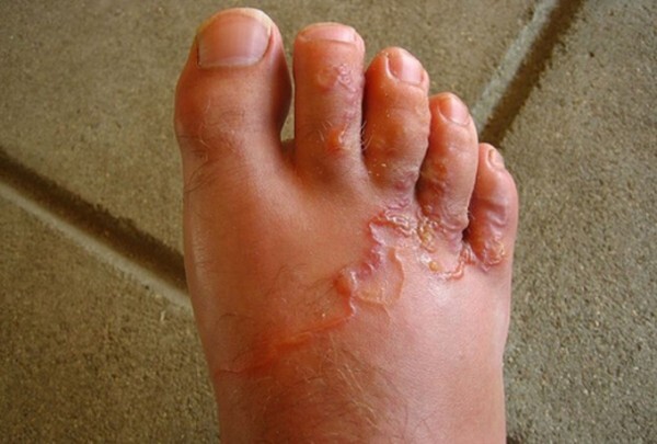 Những hiểm họa trong các món ăn tái