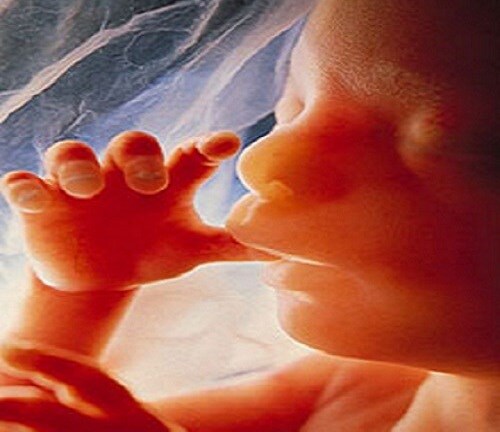 Phát hiện bào thai hóa thạch 50 năm trong bụng bà cụ 90 tuổi