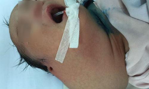 Cứu sống bé sơ sinh có khối bướu khổng lồ chiếm trọn vùng cổ