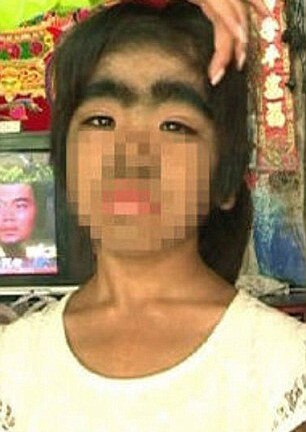 Kỳ dị cô bé 8 tuổi mắc chứng bệnh “người sói”