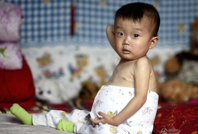 Kỳ lạ cậu bé có vòng bụng to 144 cm