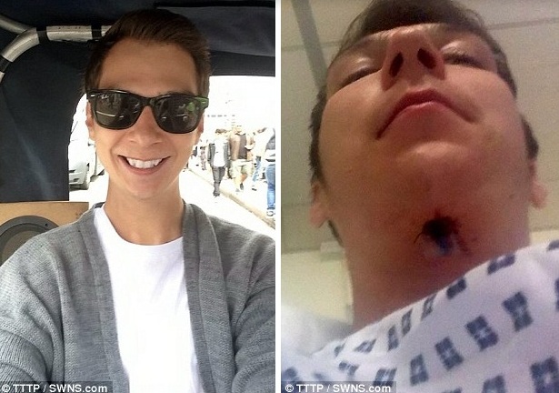 Lõm họng và suýt mất mạng vì dùng sản phẩm làm trắng răng