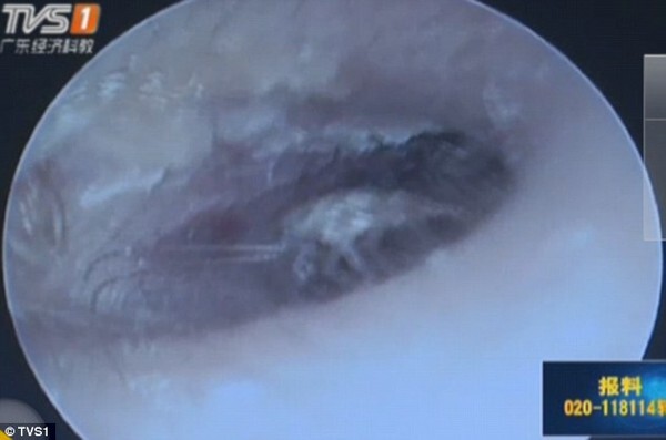 Phát hiện ra một ổ gồm 25 gián con và 1 gián mẹ trong tai người