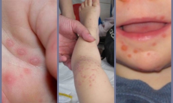 Bệnh tay chân miệng ở trẻ cần kiêng những gì?