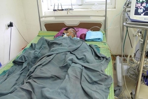 Vật lạ phát nổ làm bé trai 9 tuổi đa chấn thương là tụ điện bóng cao áp