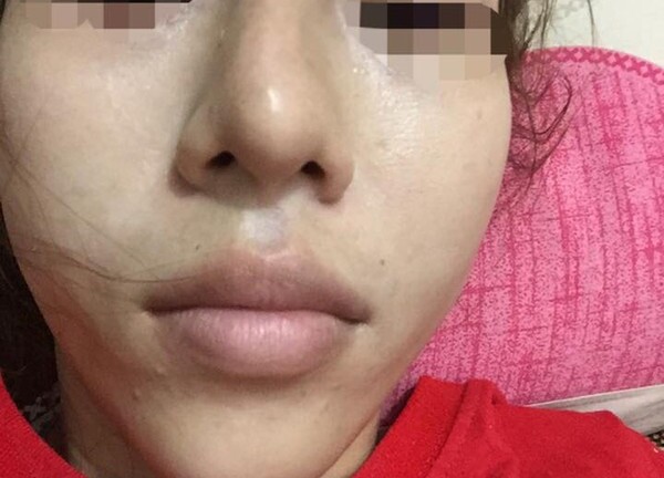 Ham rẻ tiêm chất làm đầy rởm: Hoại tử mũi, biến dạng cằm