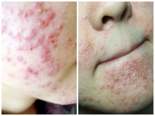 Chuyên gia khuyến cáo cách phòng dị ứng chất bảo quản sản phẩm làm đẹp