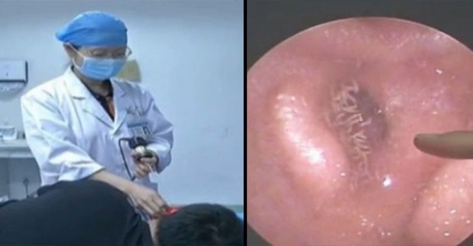 Tá hỏa khi thấy ấu trùng ruồi lúc nhúc trong tai