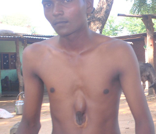  Trái tim nằm ngoài lồng ngực, chàng trai vẫn sống sót kỳ diệu