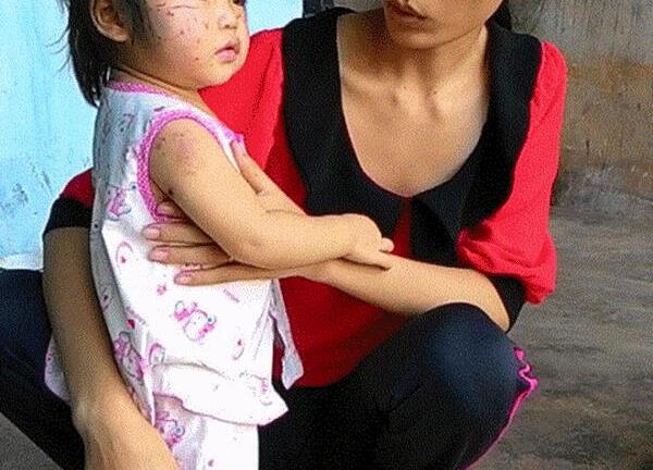 Bé gái bị cào cấu rách mặt: Gia đình yêu cầu cô giáo bồi thường tới khi hết sẹo