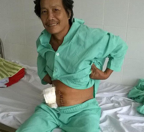 Nuốt tăm tre trong lúc say, người đàn ông bị chọc thủng đại tràng